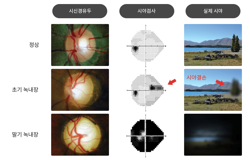 녹내장 그래프