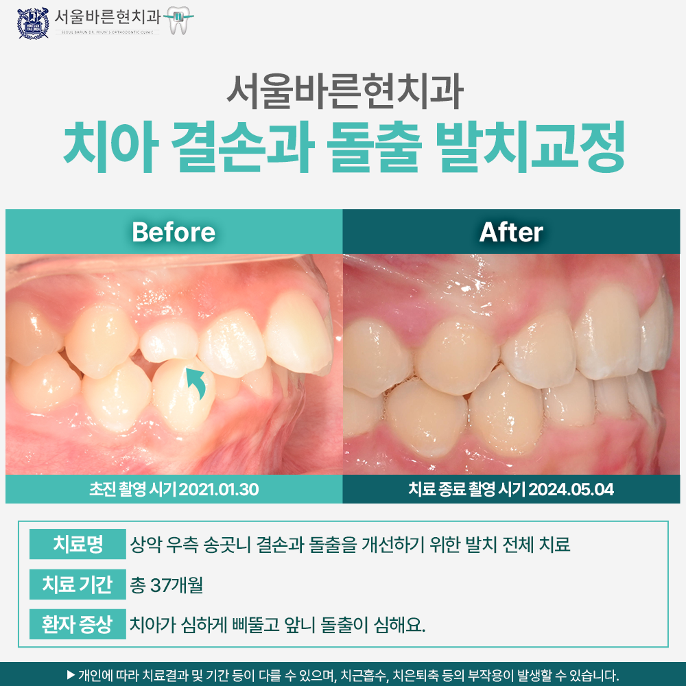 해운대치아교정