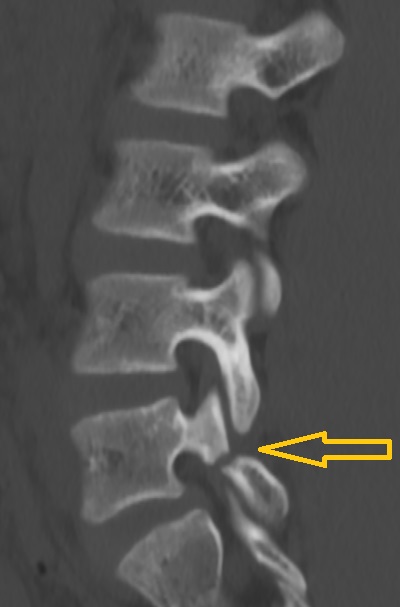 척추 분리증 (spondylolysis)의 CT 측면 소견.