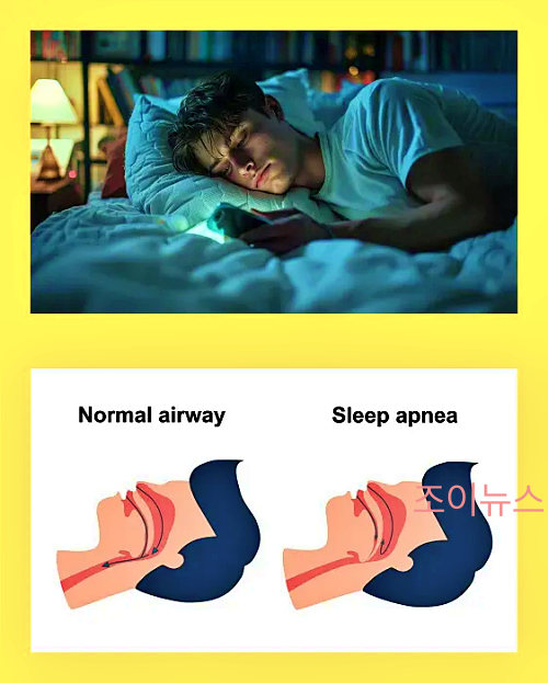 야간뇨의 발생 원인, 수면 무호흡증의 이해를 돕는 사진(하)