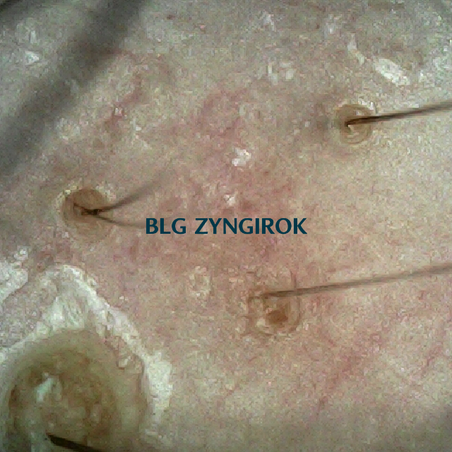 피나모아 복용 13주차 두피 사진 - 오른쪽 M자 부위 모습이다.