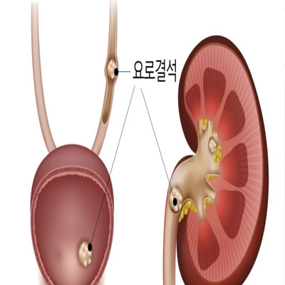 요로결석증상원인