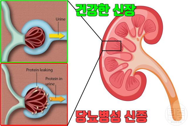 추위 잘 타는 사람 특징 질환 당뇨 합병증