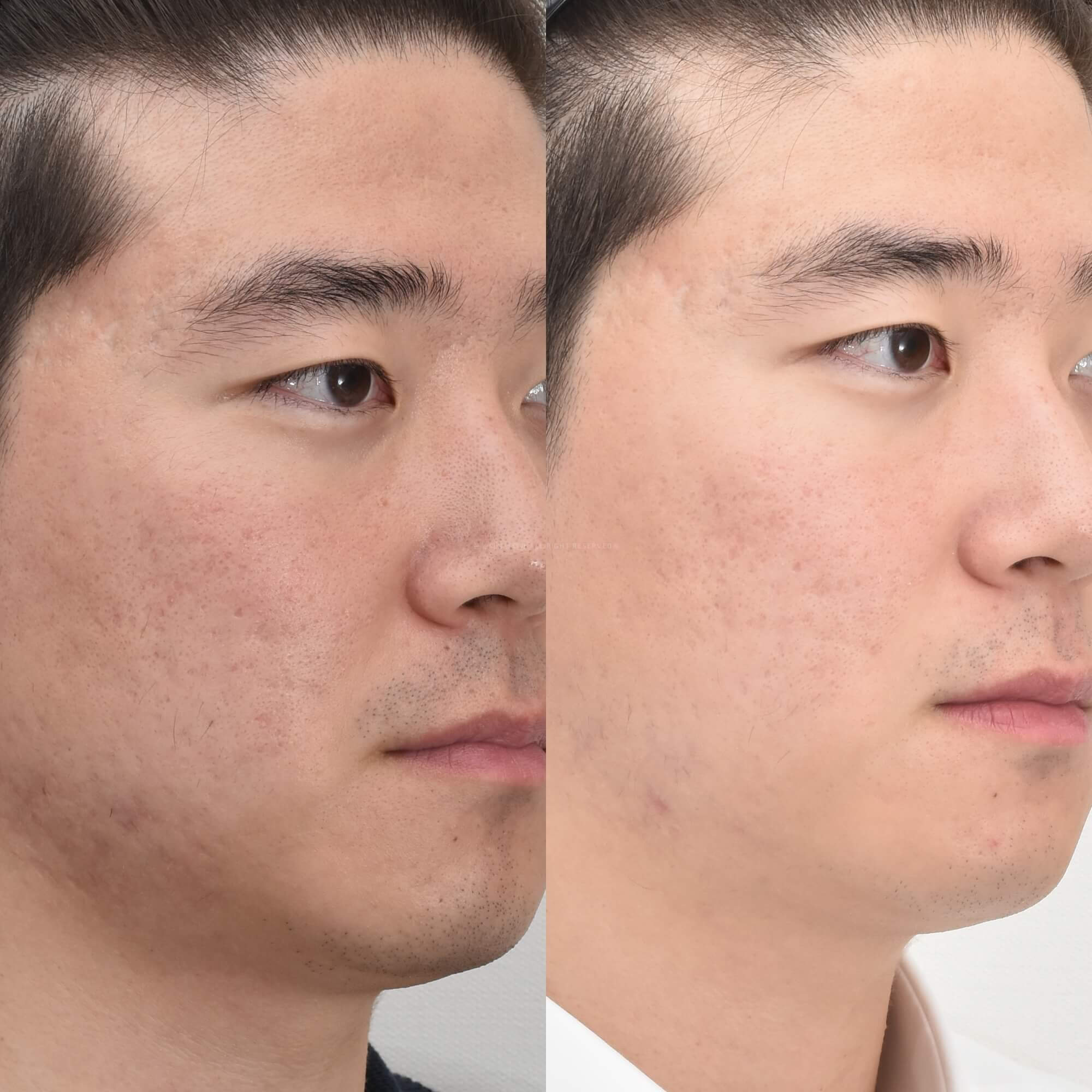 여드름흉터피부과