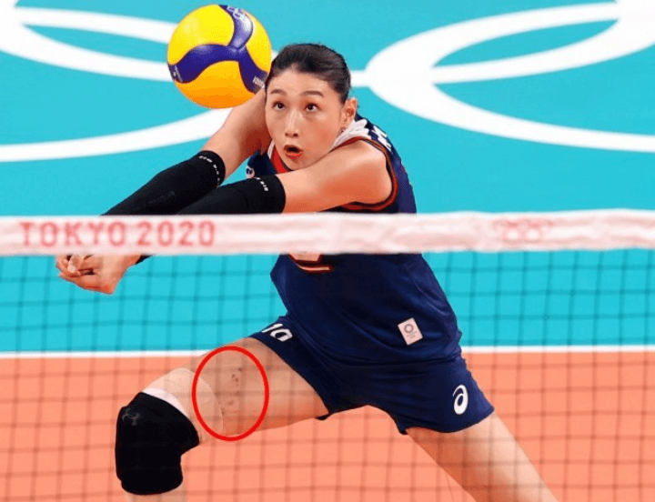 김연경선수-허벅지핏줄-터짐-일본전