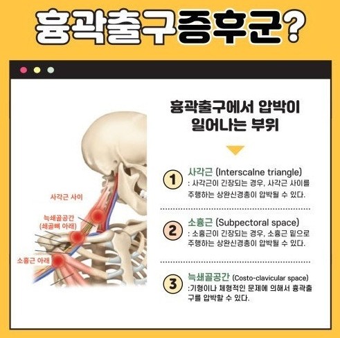 흉곽출구증후군