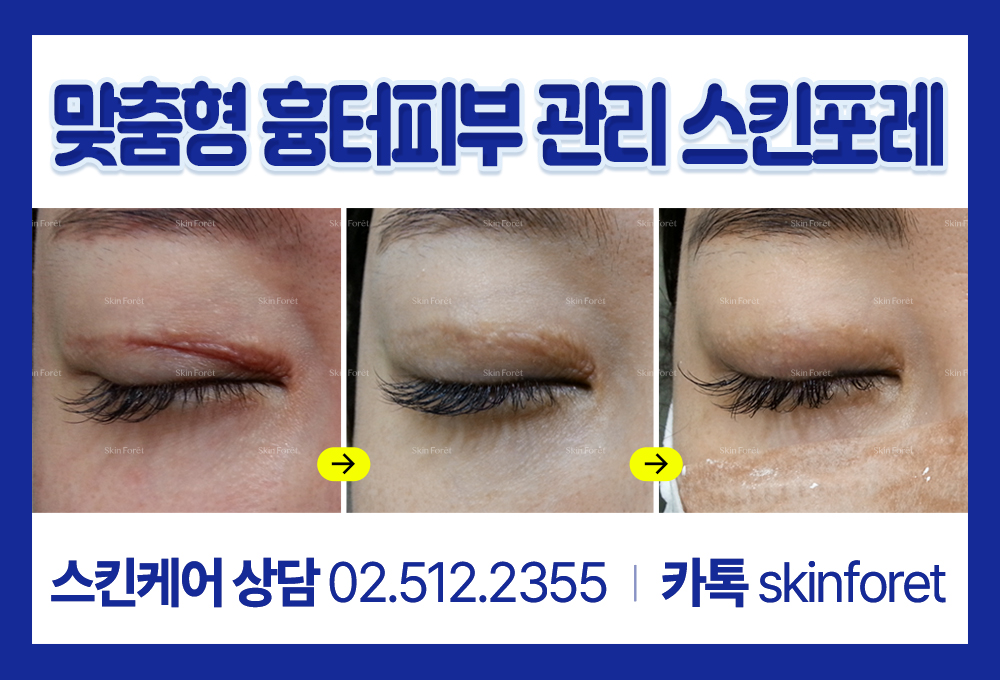 쌍꺼풀 흉살과 눈 재수술 케어, 스킨포레