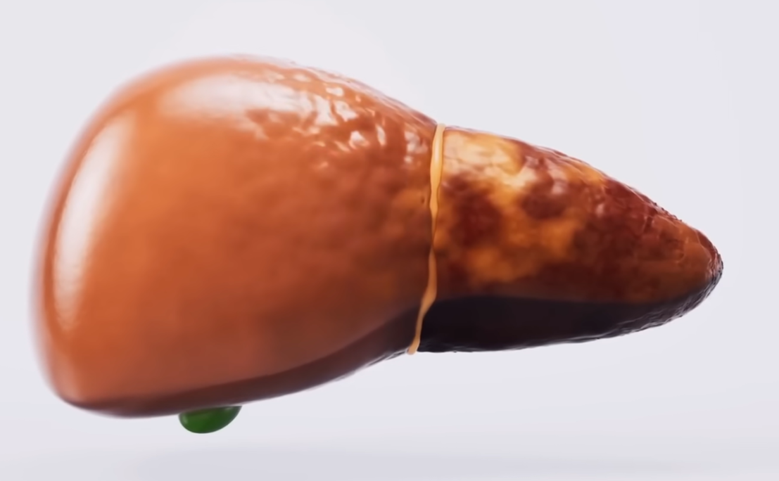 간수치 내리는 방법