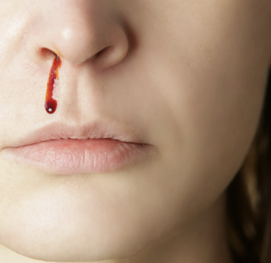 코피가 자주나는 이유 10가지 총정리 섬네일