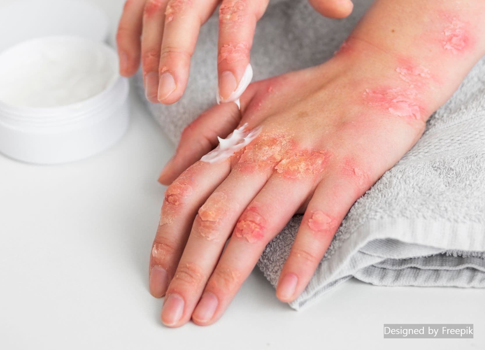 해파리 쏘임 응급처치