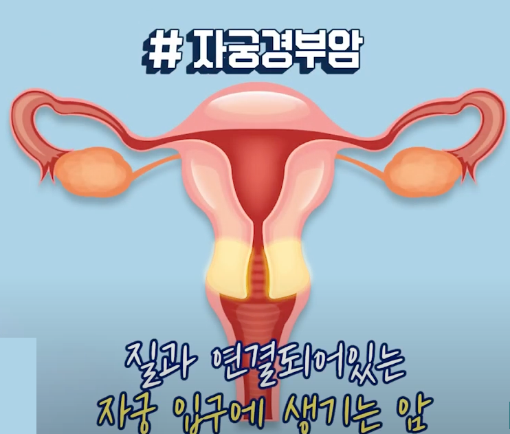 자궁경부암이란