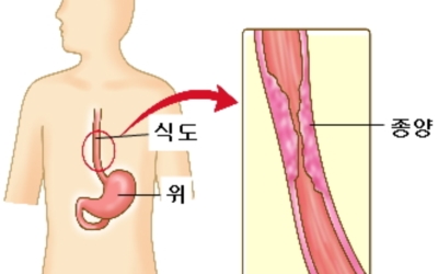 식도암이미지