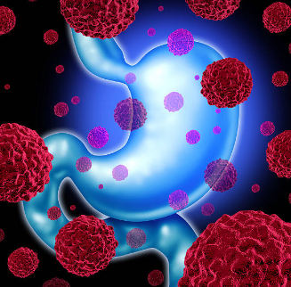 위암 초기증상, 수술비용, 수술후 회복기간 총정리 (2024ver)