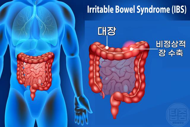 배에 가스가 차는 이유 배에 가스차서 아플때 과민성장증후군 가스형