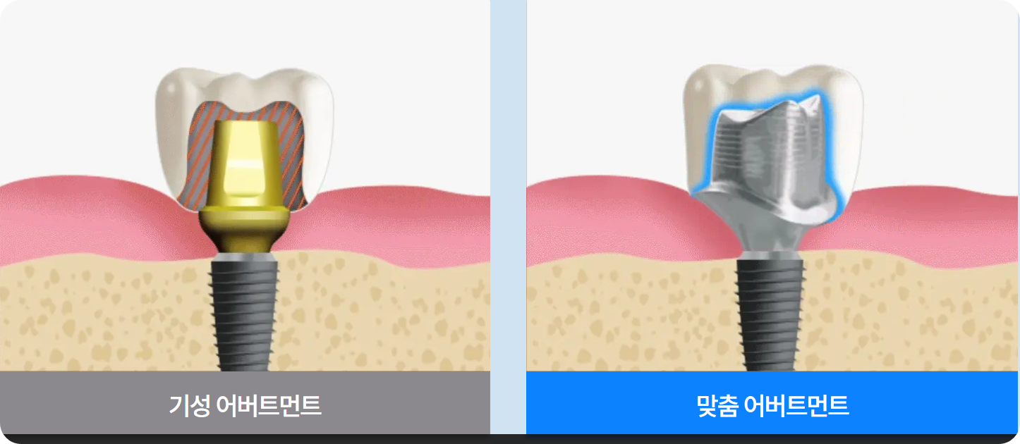임플난트 시술방법