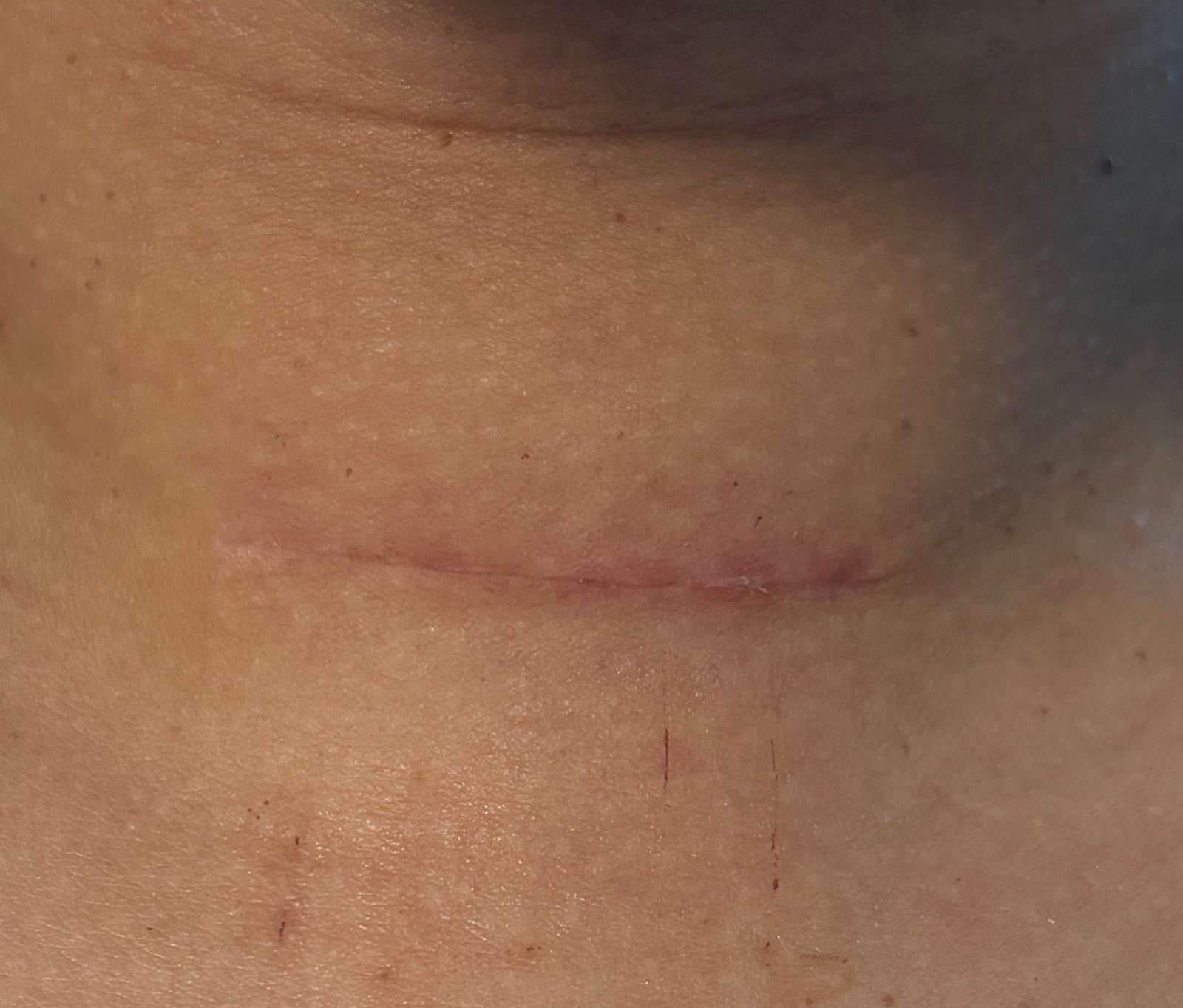 갑상선암 절제술에 필연적으로 따르는 절개 흉터입니다. 제 흉터를 직접 촬영하였습니다.