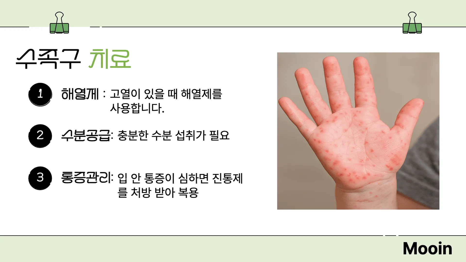 수족구 치료