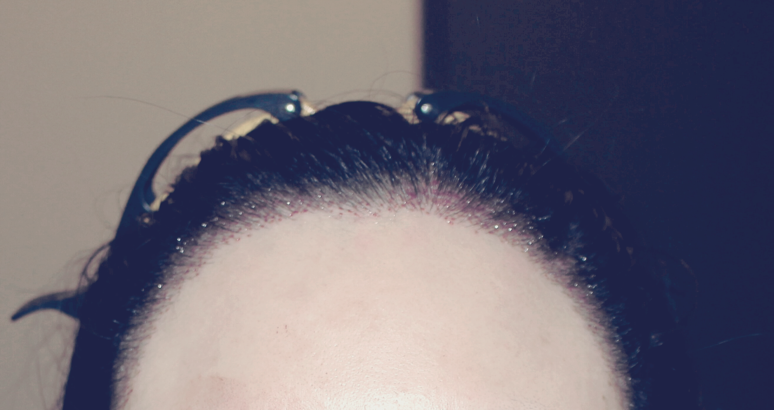 2차 보강 수술 정면