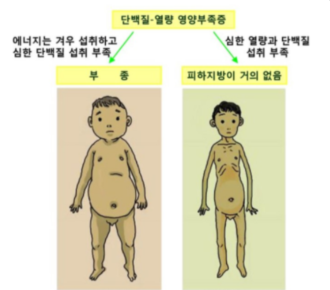 알부민 부종 증상