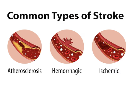 고지혈증 약의 부작용 35