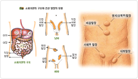 스포츠 탈장