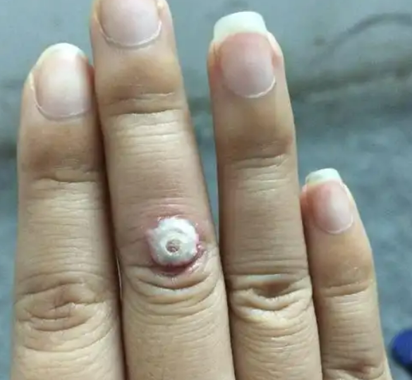 약국 티눈약으로 뿌리까지 제거하려면, 어떻게 해야할까?