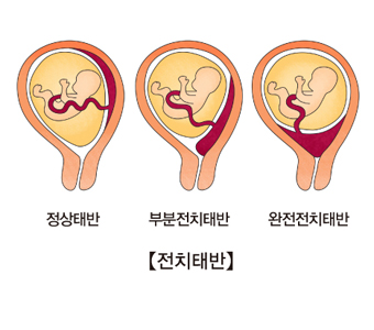 전치태반 종류 설명에 관한 사진