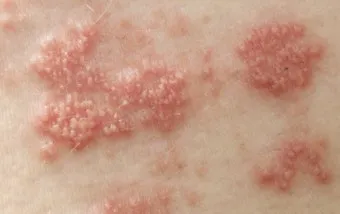 경기도 대상포진 무료접종 연령 기준 정리로 안내_2