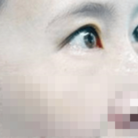 눈가보톡스 후 모습