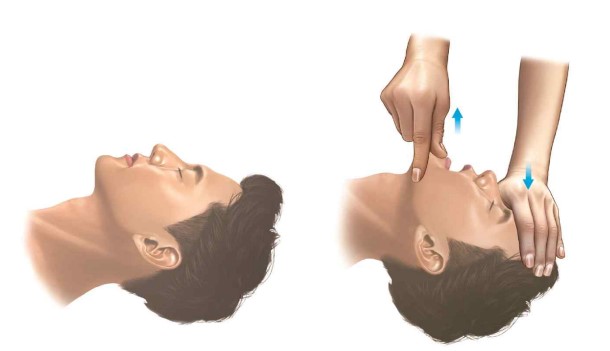 기도확보 : 머리 기울임 - 턱 들어 올리기