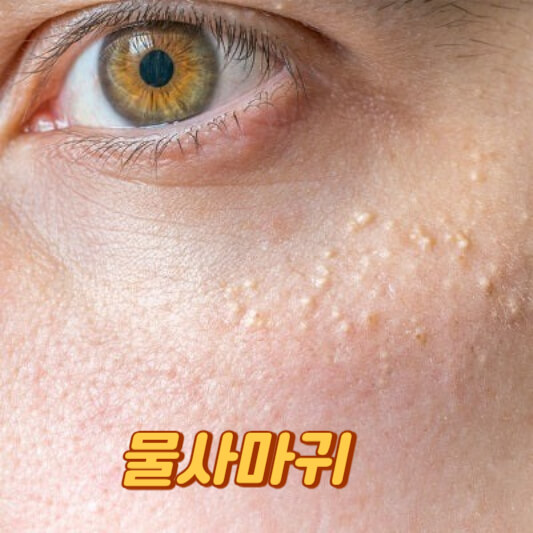 물사마귀