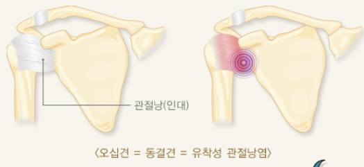 오십견 증상 2