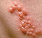 대상포진 통증 원인