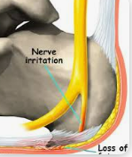 족저 근막염의 원인과 증상, 제대로 알고 계신가요?