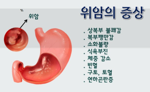 위암 증상 이미지