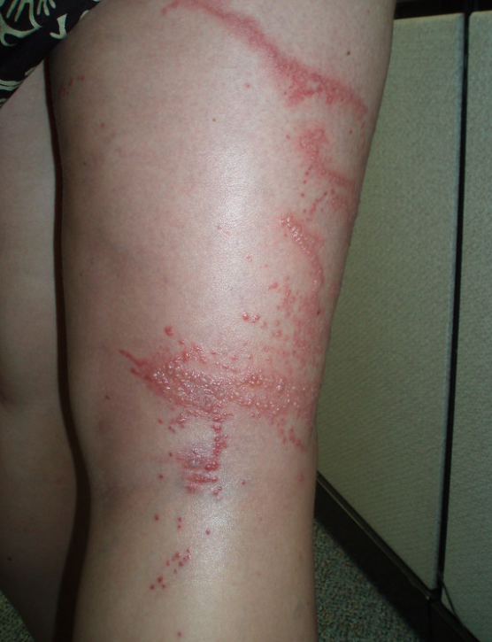 해파리 쏘였을때 관련 이미지4