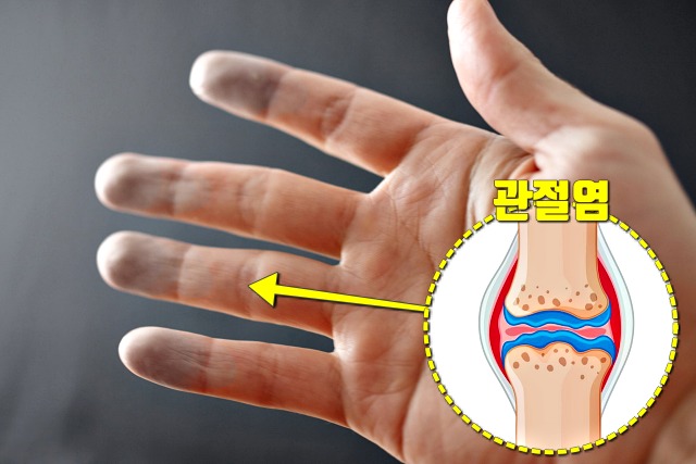 추울때 손가락 끝이 하얗게 레이노 증후군 증상 류마티스 관절염 루프스 피부괴사