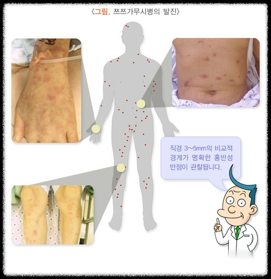 가을철 진드기 감염병 주의보: 예방 방법과 대처 요령