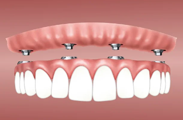 임플란트 종류와 선택 방법