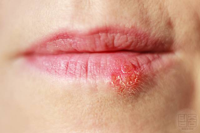 입술 뾰루지 종기 헤르페스 음식알러지