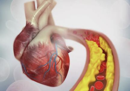 고지혈증에 좋은 음식 나쁜 음식 관리방법 파헤치기