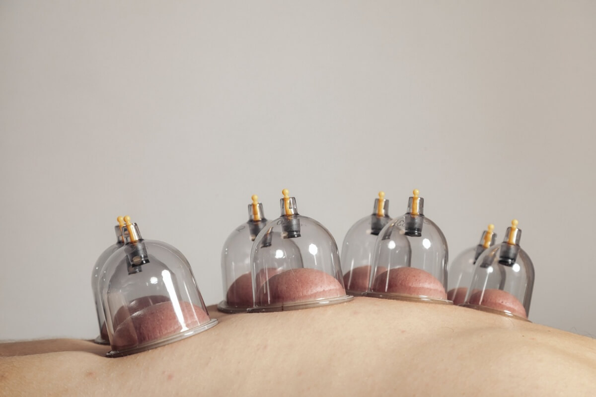 부항치료를-하고있는-모습