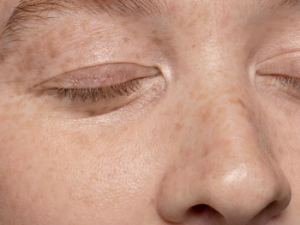 검버섯 없애는 방법