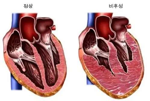 비후성심근병증