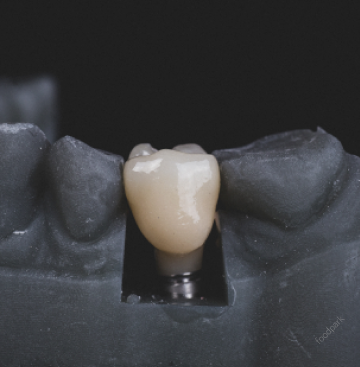 라미네이트 부작용