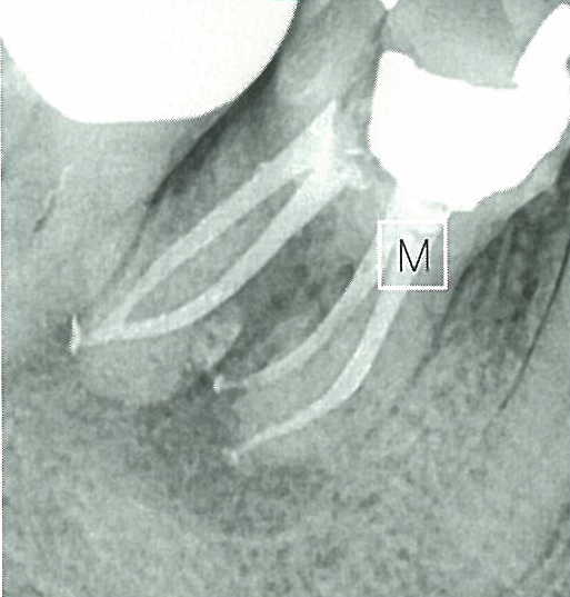 근관치료된 치아
