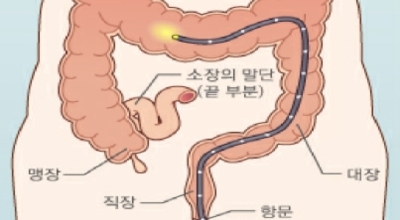 대장내시경이미지
