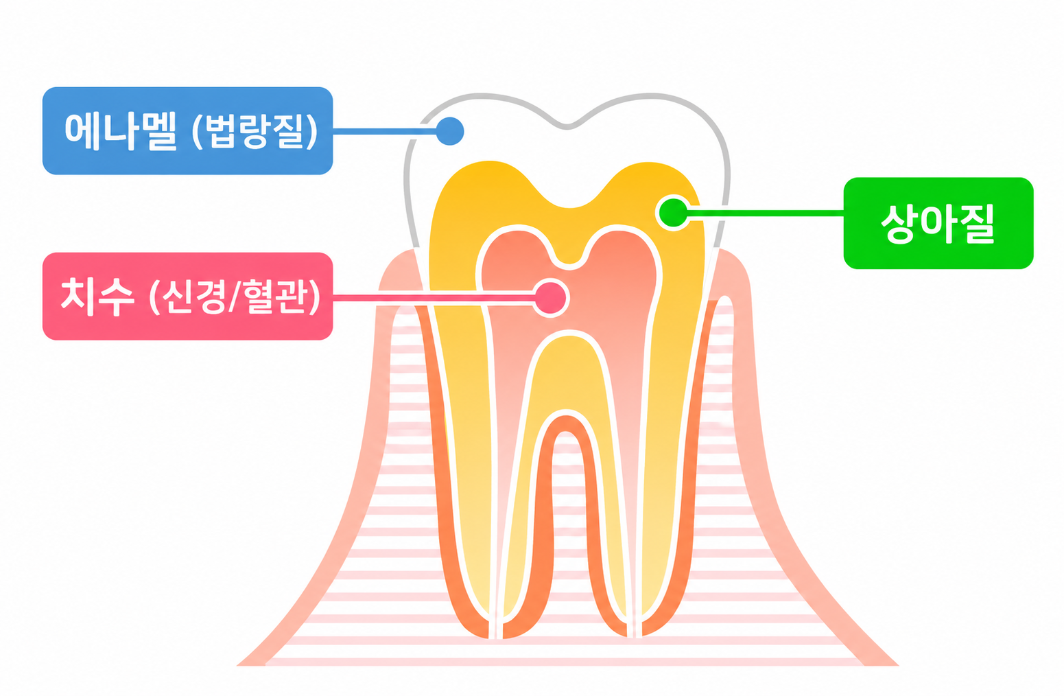 산성 성분에 의해 일시적으로 부드러워지는 치아 가장 겉면인 법랑질(Enamel)의 위치를 시각적으로 보여주는 다이어그램