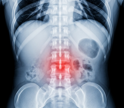 허리통증을 의미하는 X ray 사진