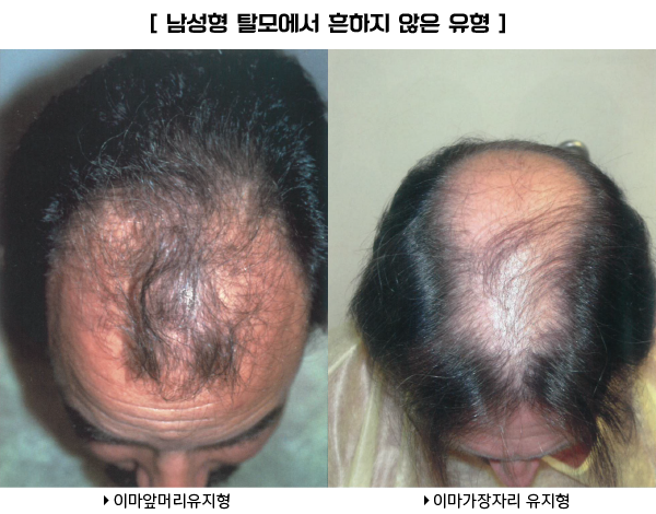 남성형 탈모에서 흔하지 않는 유형